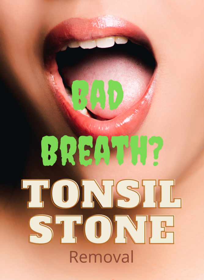 Tonsil Stones Smell? Yuck! Hidden Tonsil Stones Treatment + Surgery