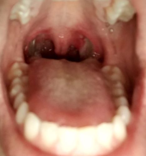 tonsil stones smell hidden tonsil stones