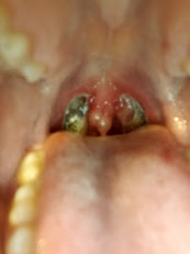 big tonsil stones hidden in throat